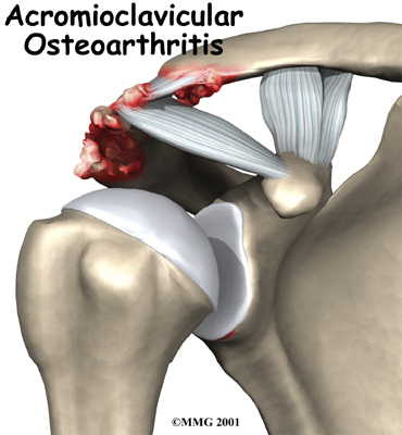 Osteoarthritis of the Acromioclavicular Joint